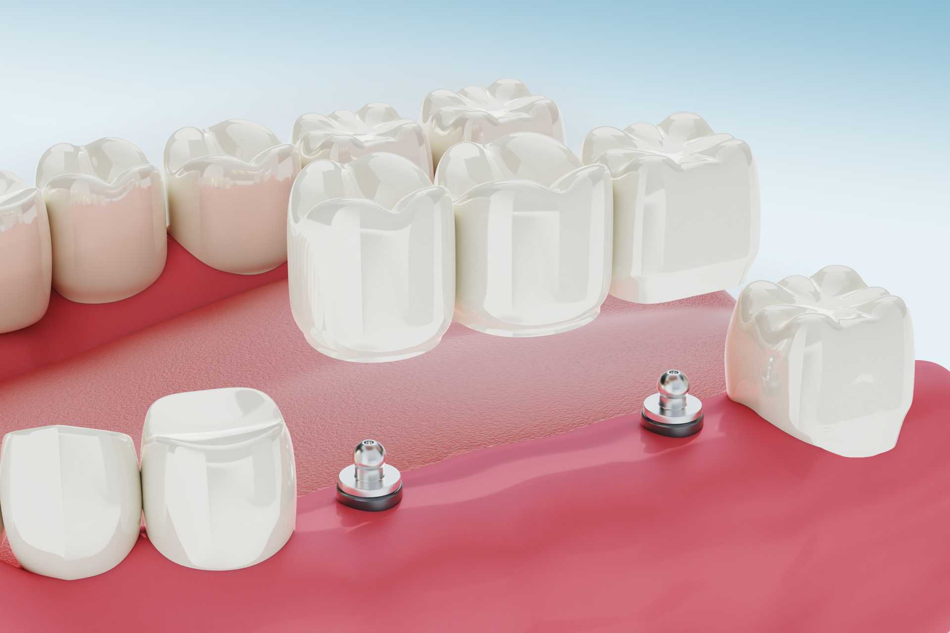 01 3D model of a triple dental prosthesis