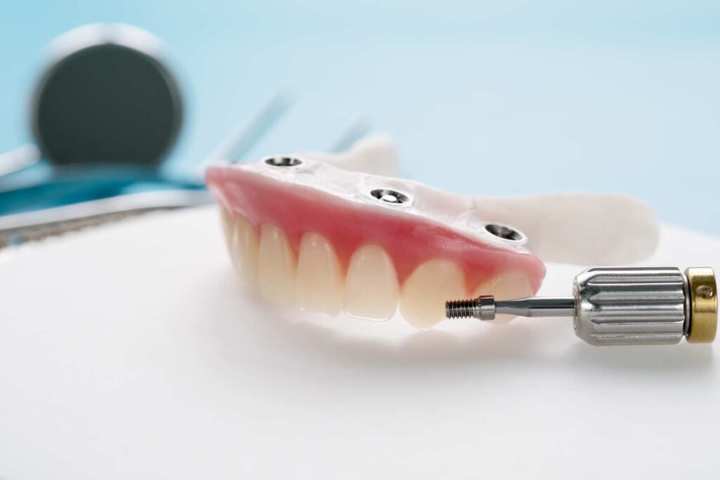 Implant overdenture: what you should know