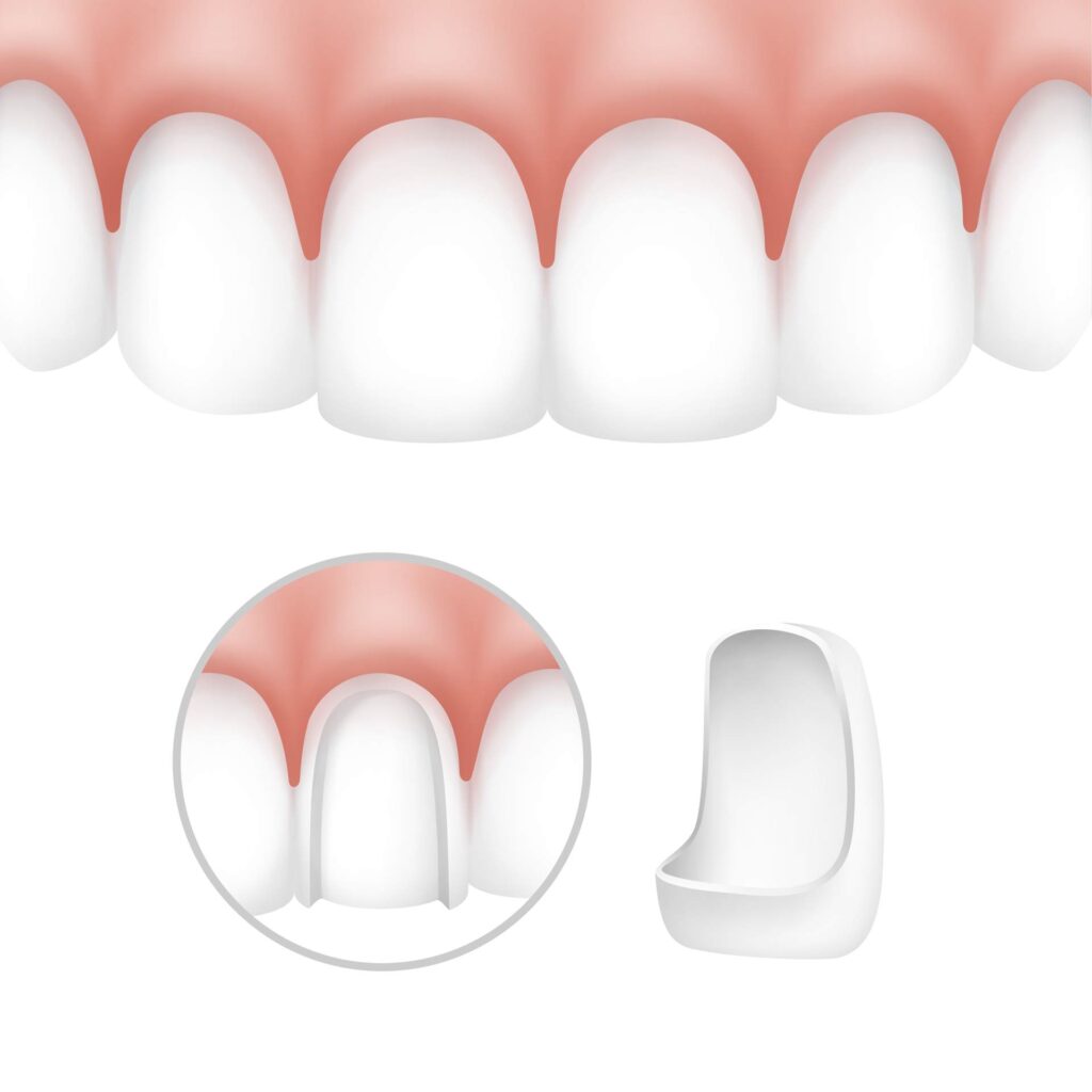 02 Diagram of porcelain dental veneers showing the grinding of the tooth to be used to place them