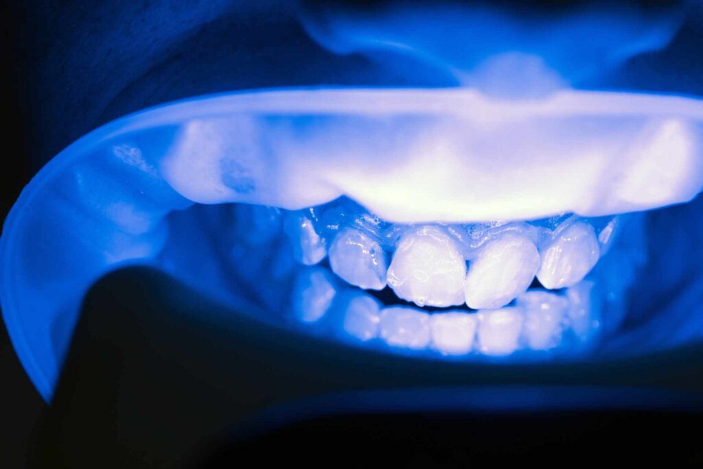 06 Teeth whitening with UV rays in a dental clinic