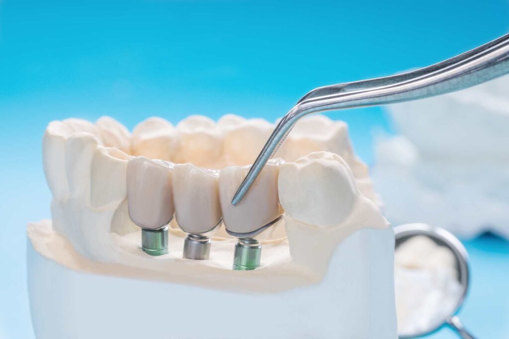 02 Closeup of a mock-up of a fixed dental bridge placed on dental implants