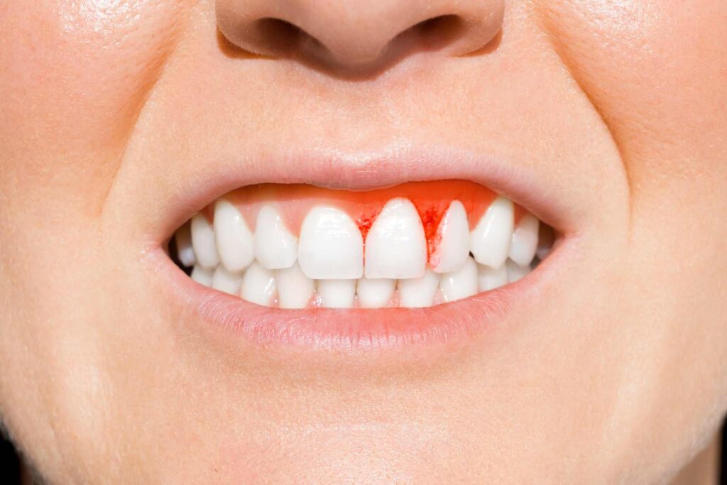 03 Young woman with inflamed and bleeding gum due to a slightly recessed gum on one tooth only