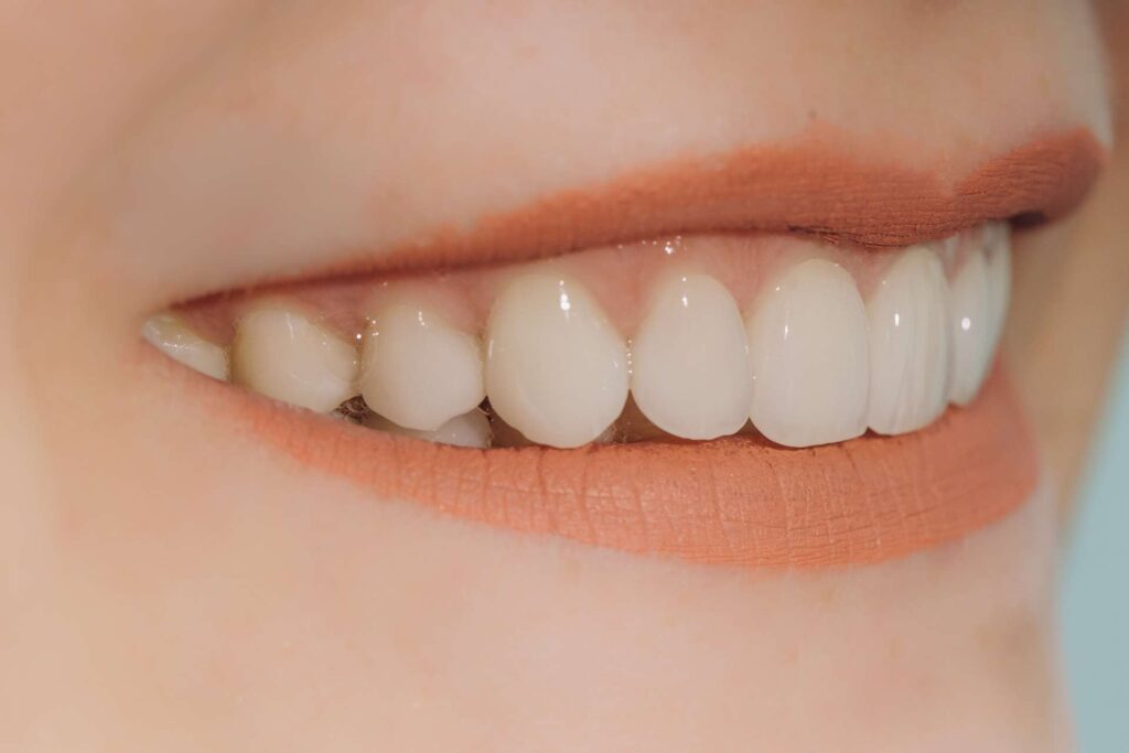 04 Woman smiling while wearing natural looking dental veneers_Do porcelain veneers break easily - composite veneers vs. porcelain veneers