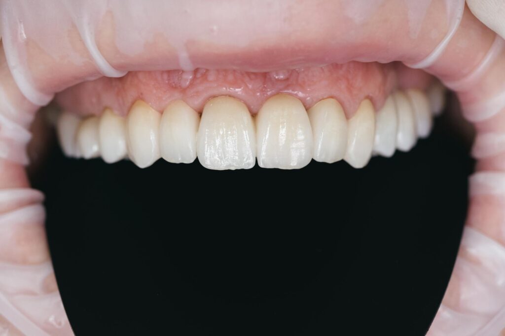 07 Close up of a denture with artificial zirconia or zirconia teeth_Do porcelain veneers break easily - composite veneers vs. porcelain veneers