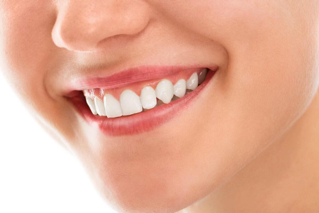 07 Closeup of a woman smiling with white teeth_Lumineers vs. porcelain veneers