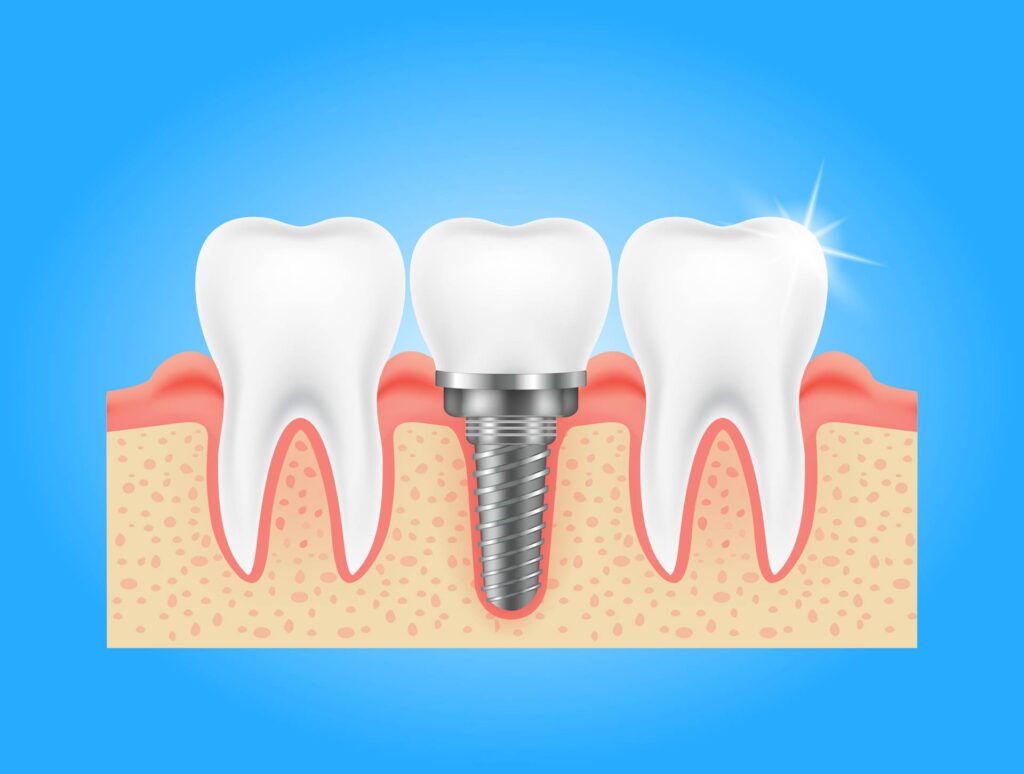 03 Illustration of a dental implant with crown between two natural teeth_Types of dental implants