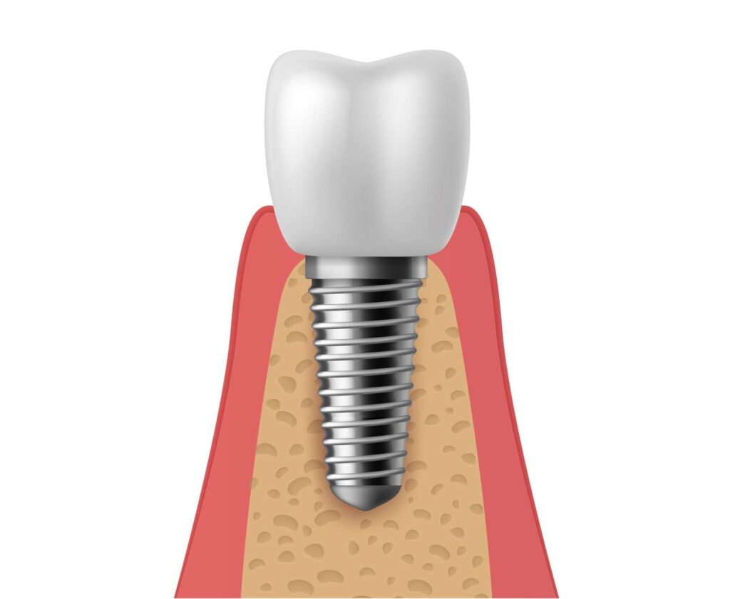 03 Realistic illustration of a screw type dental implant_What is the risk of dental implants_Dental implants pros and cons