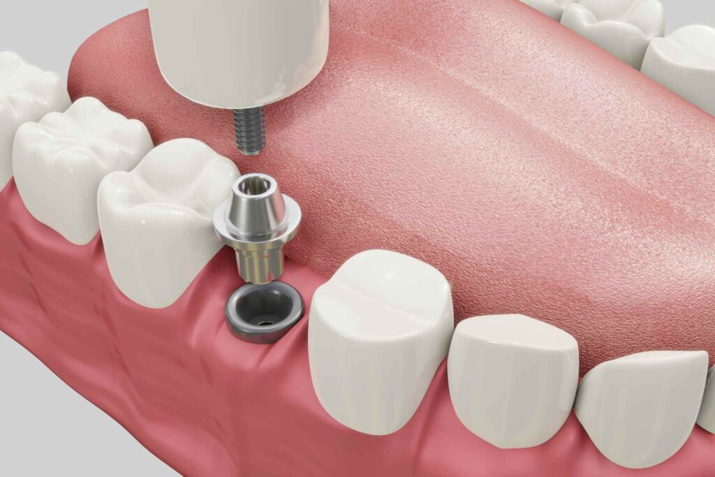 04 3D mock-up of a denture with a dental implant and an abutment to which a crown is screwed_How long after dental implants