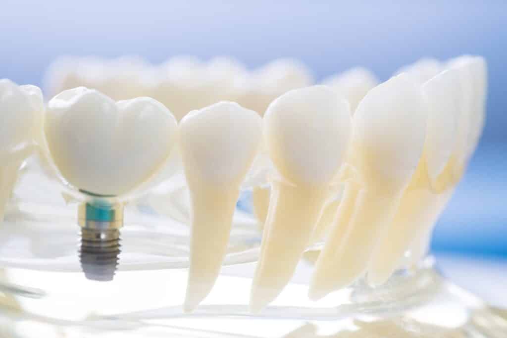 05 Translucent mock-up of a human denture with a screw-in dental implant_What is the risk of dental implants_Dental implants