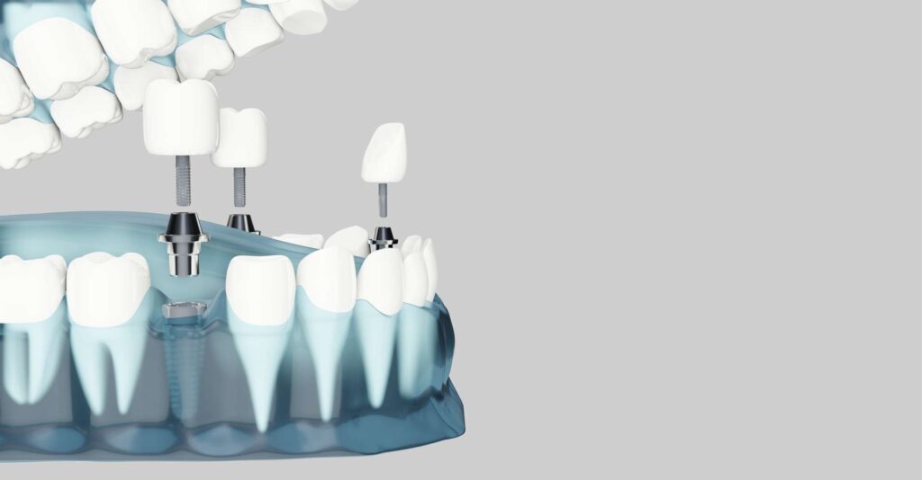 06 3D illustration illustrating the placement of dental crowns on abutments and dental implants_Procedure of dental implants