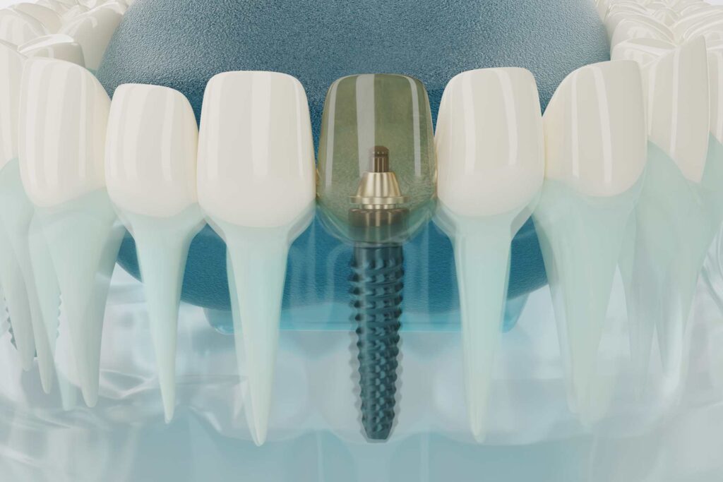 06 3D translucent mock-up of a screw-retained dental implant with crown already in place_Do dental implants hurt