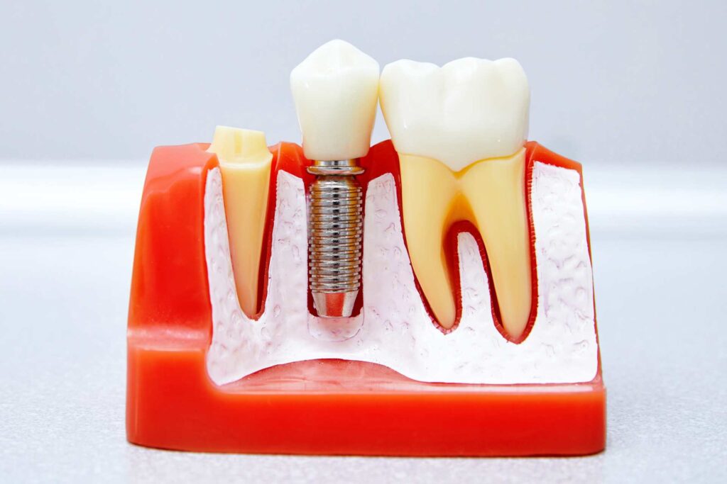 06 Sectional side view of the mock-up of a metallic dental implant_Types of dental implants