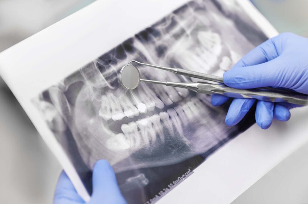 07 A dentist examining a dental X-ray film_What is the risk of dental implants_Dental implants pros and cons