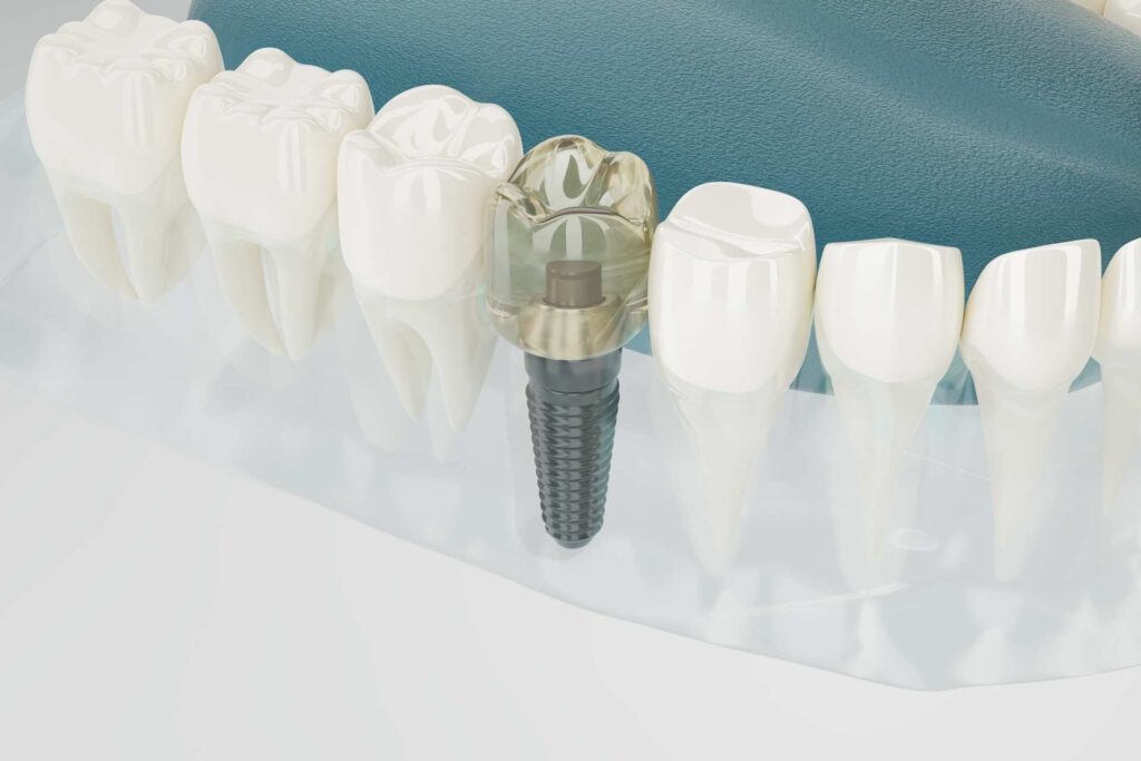 07 Didactic 3D recreation of a dental implant with abutment and translucent crown to show its structure_Types of dental implants