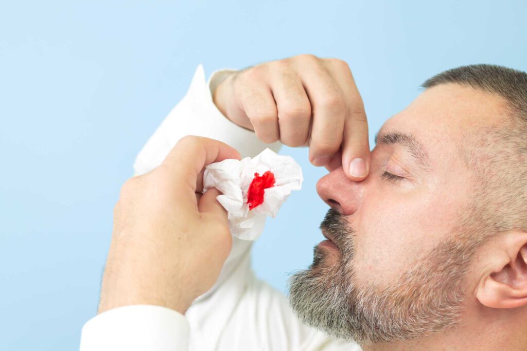 07 Man bleeding from his nose and wiping it with a napkin_Recovery of dental implants, Dental Implants in Miami