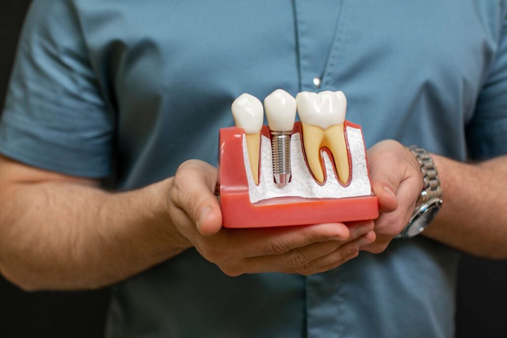 08 Close-up of an enlarged human dentition mock-up with healthy molars and a dental implant with crown_How long after dental