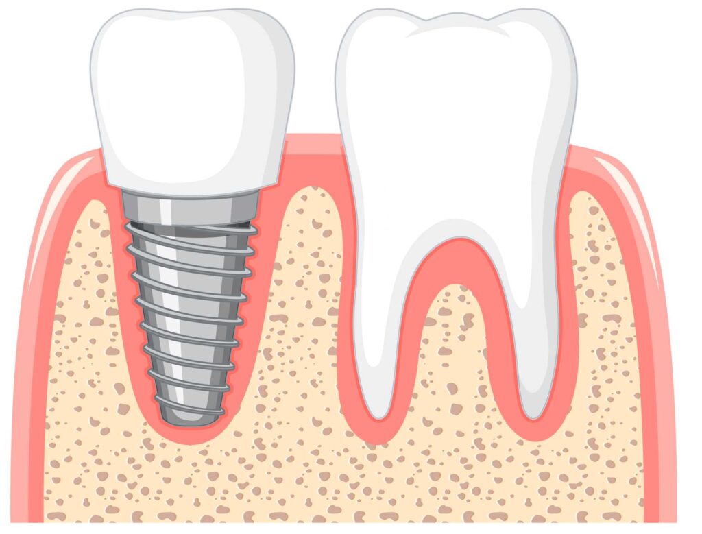 08 Drawing of a healthy tooth next to a metal dental implant_Recovery of dental implants, Dental Implants in Miami