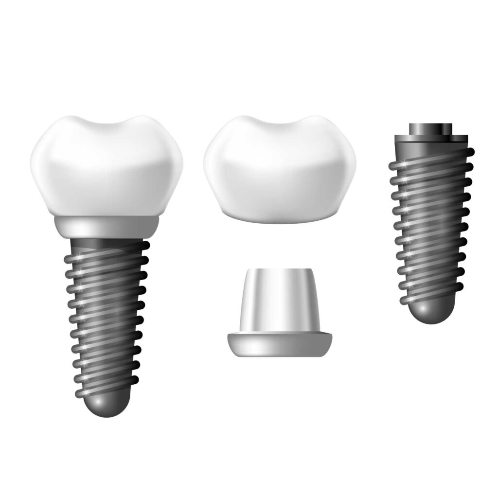 10 Diagram showing the structure of a dental implant consisting of post, abutment and crown.