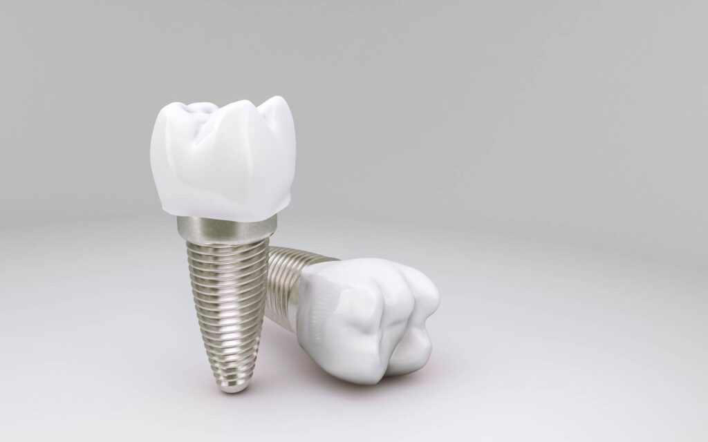 11 3D mock-up of a dental implants with crowns_Dental implants pros and cons, dental implants in Miami