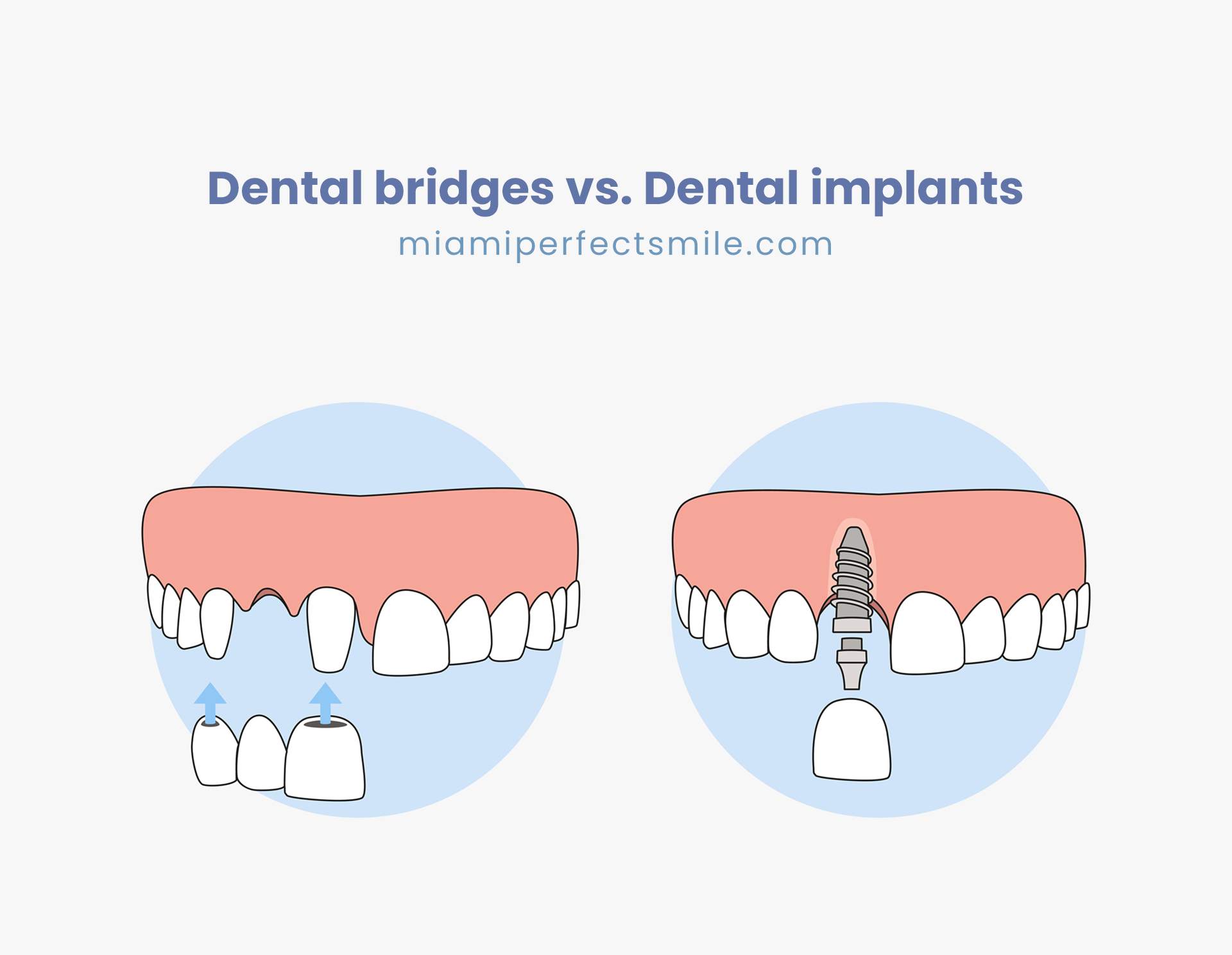 01 Dental bridges vs Dental implants Miami Perfect Smile dental bridges vs dental implants