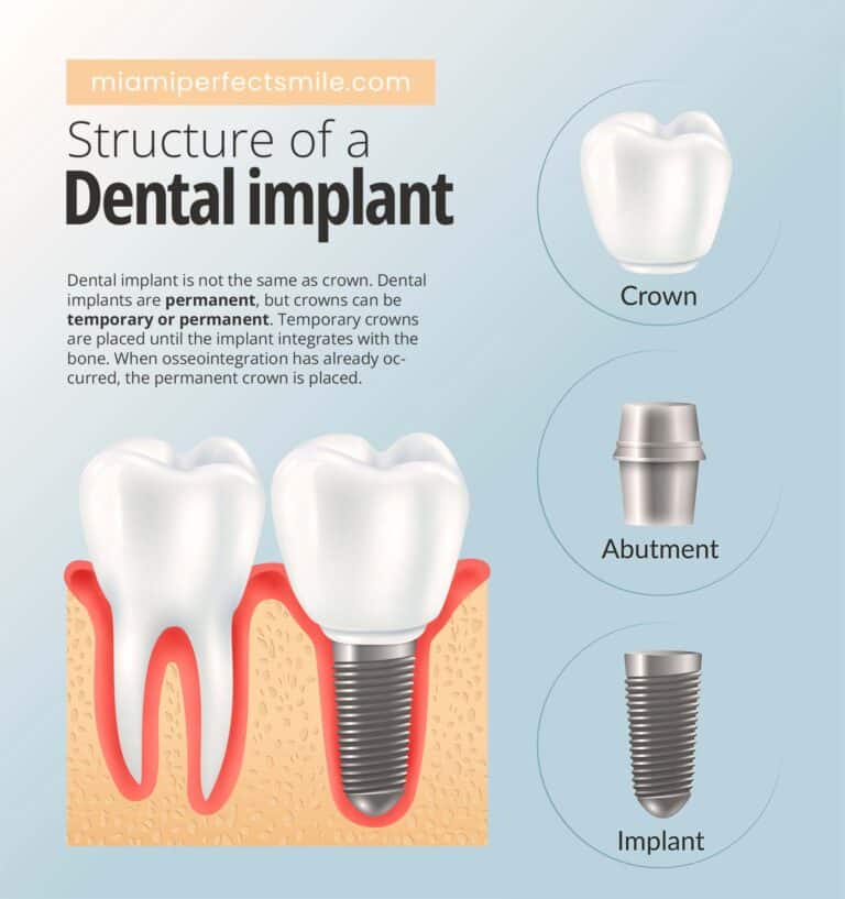 01 Structure of a dental implant_Difference between temporary and permanent dental implants - Miami Perfect Smile
