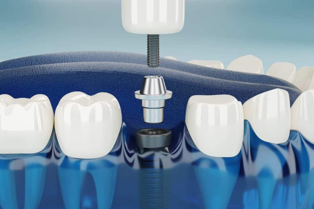 02 Close-up of the 3D structure of a dental implant with abutment and crown