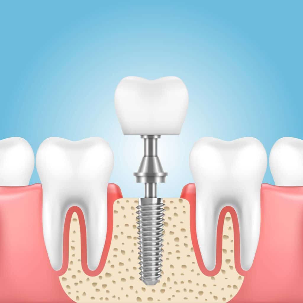 02 Image illustrating the structure of a dental implant