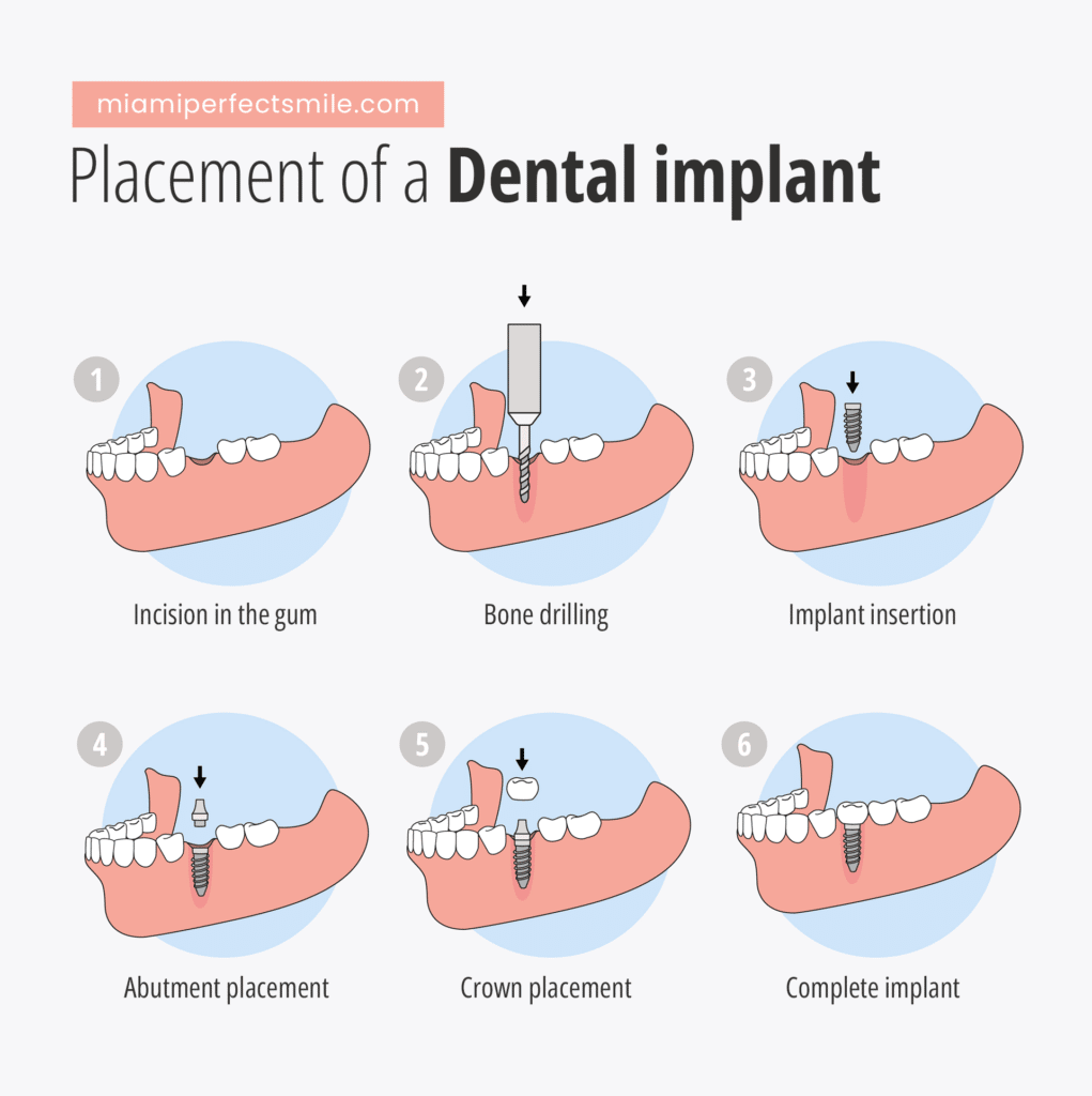 03 Dental implant placement infographic_Difference between temporary and permanent dental implants - Miami Perfect Smile