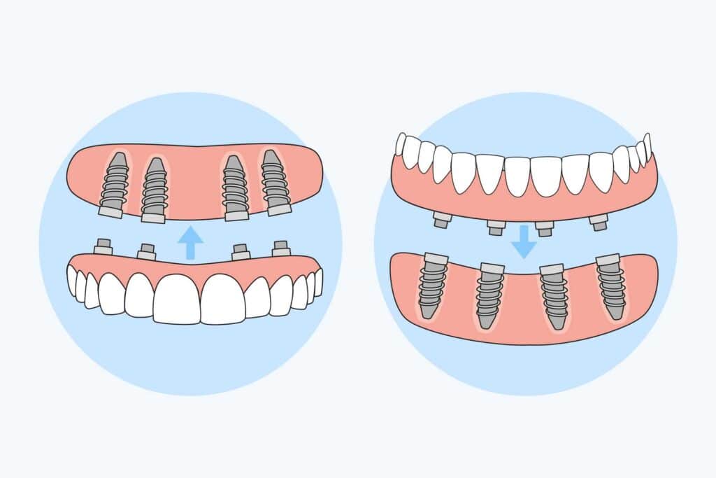04 Illustration of complete dental prosthesis on maxillary and mandibular implants