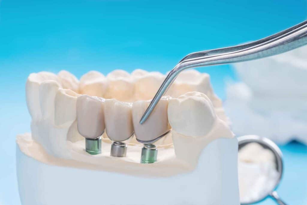 05 3D model of dental implants