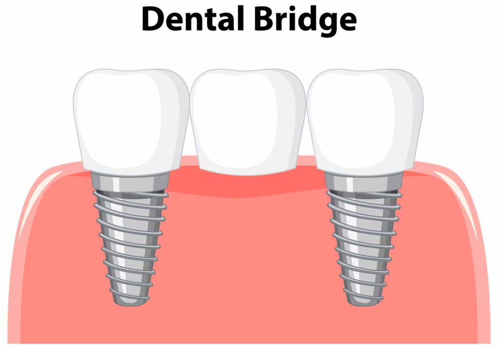 06 Illustration of a dental bridge over two implants