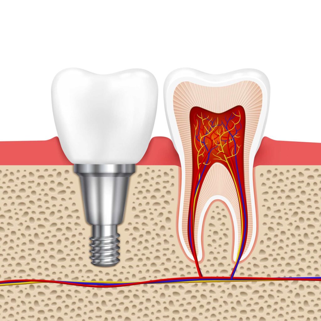 06 Illustration of the structure of a dental implant next to a molar