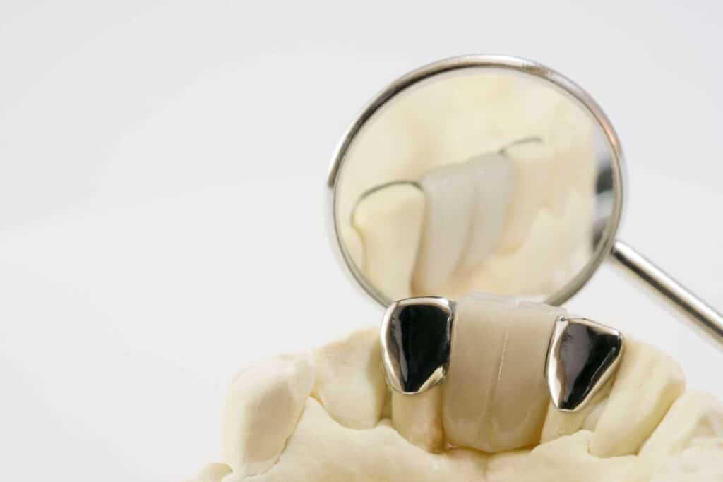08 Front and back view of a Maryland metal dental bridge_dental bridges vs dental implants