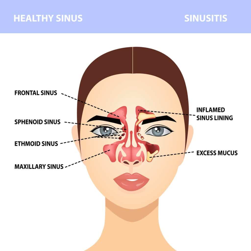 08 Illustration explaining the difference between normal sinus and sinus with sinusitis
