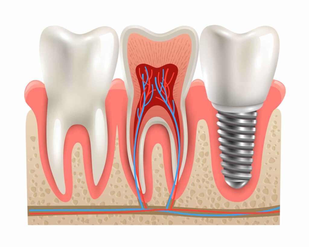 09 Anatomy of a dental implant and a normal tooth_dental bridges vs dental implants