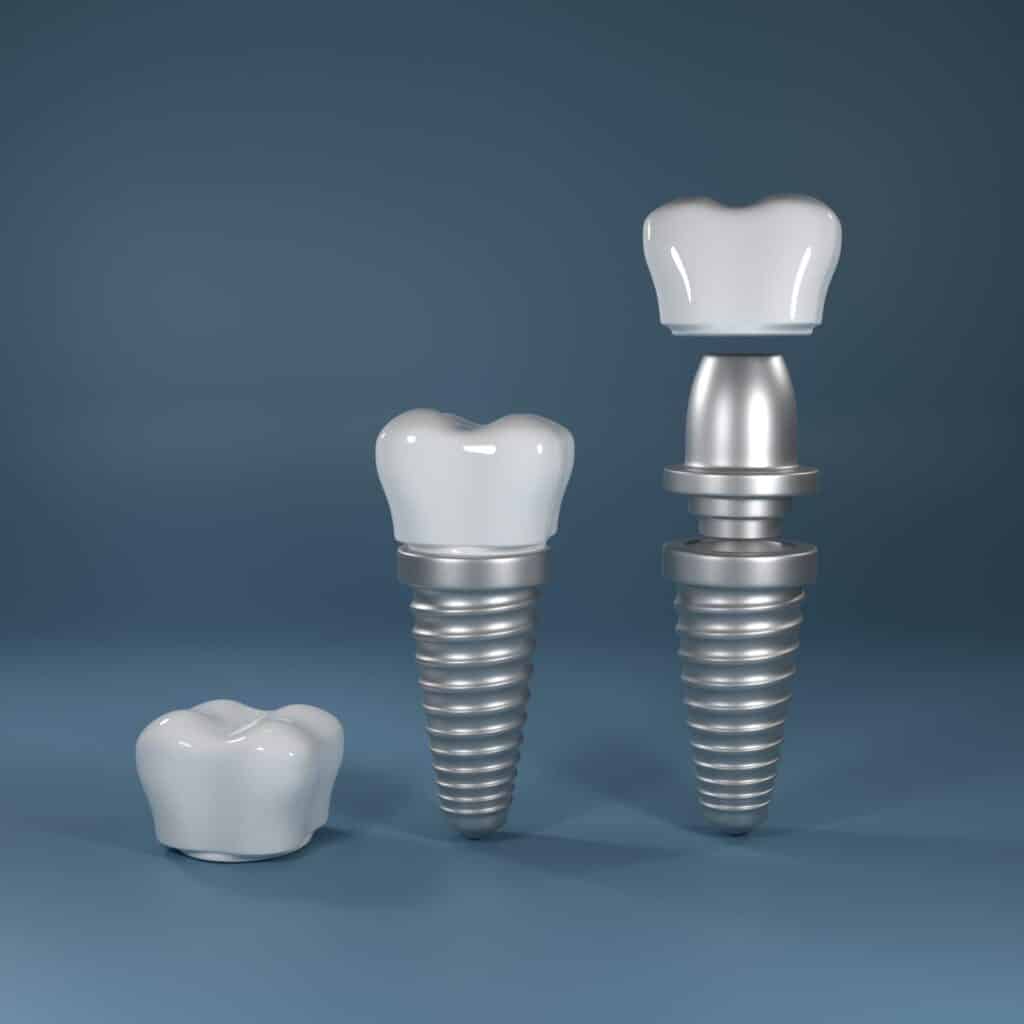 10 3D image of the parts of a dental implant with crowns_dental bridges vs dental implants