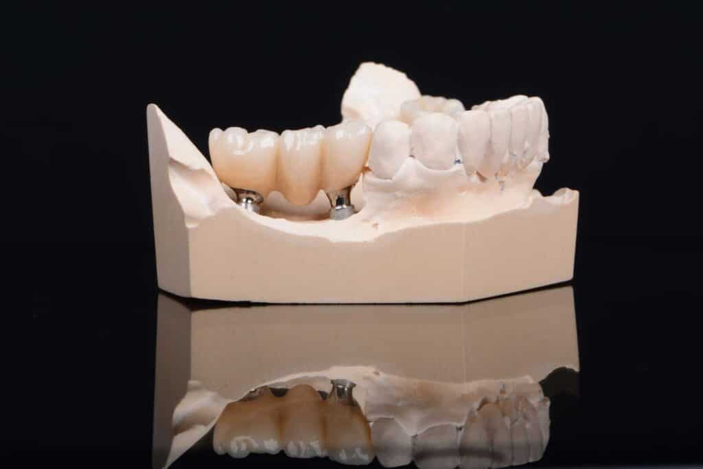 11 3D model of a bridge on 2 dental implants_dental bridges vs dental implants