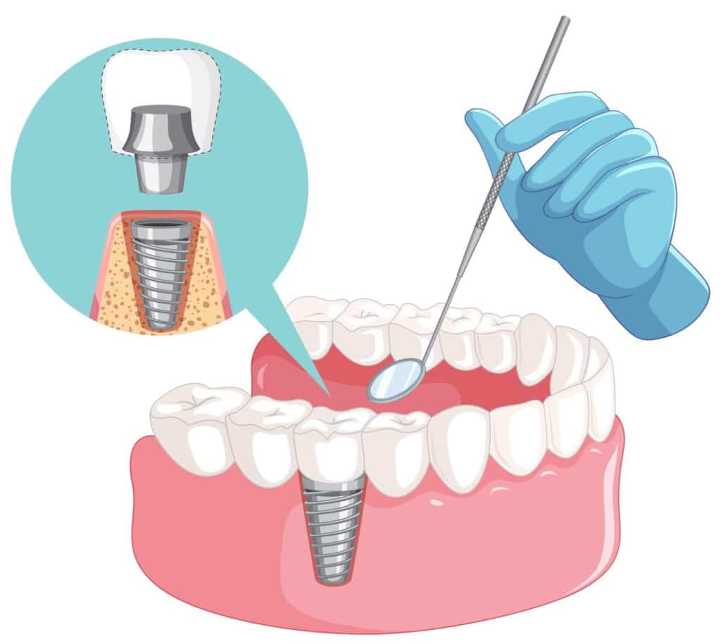12 Image of the structure and placement of a dental implant_dental bridges vs dental implants