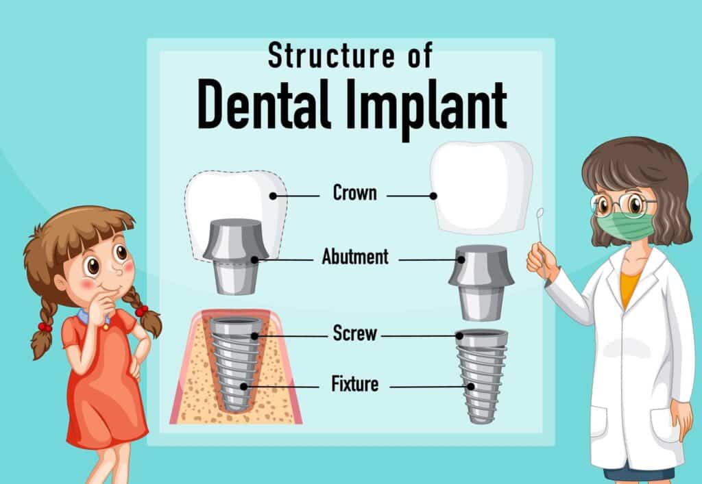 13 Titanium dental implant framework, separate implant and abutment
