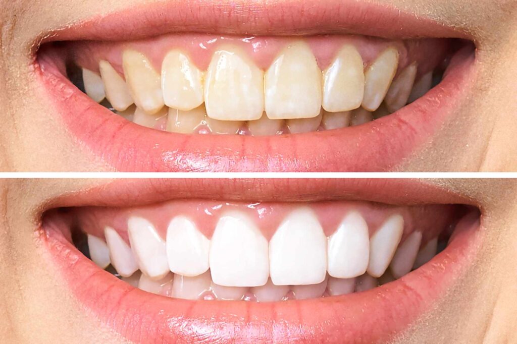 Teeth before and after teeth whitening_tooth whitening Miami