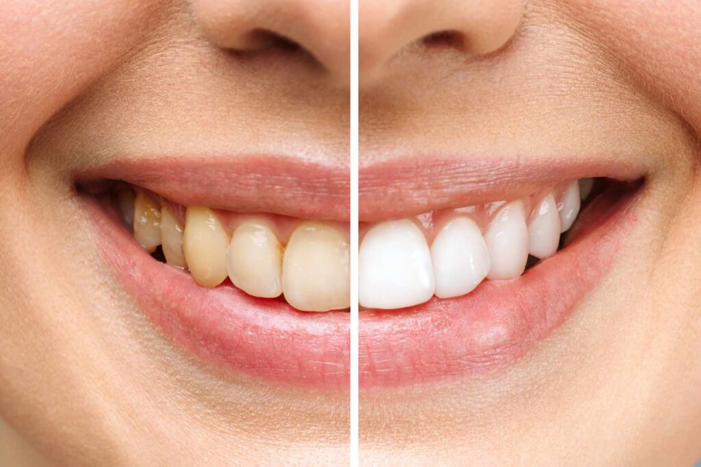 03 A woman's teeth before and after teeth