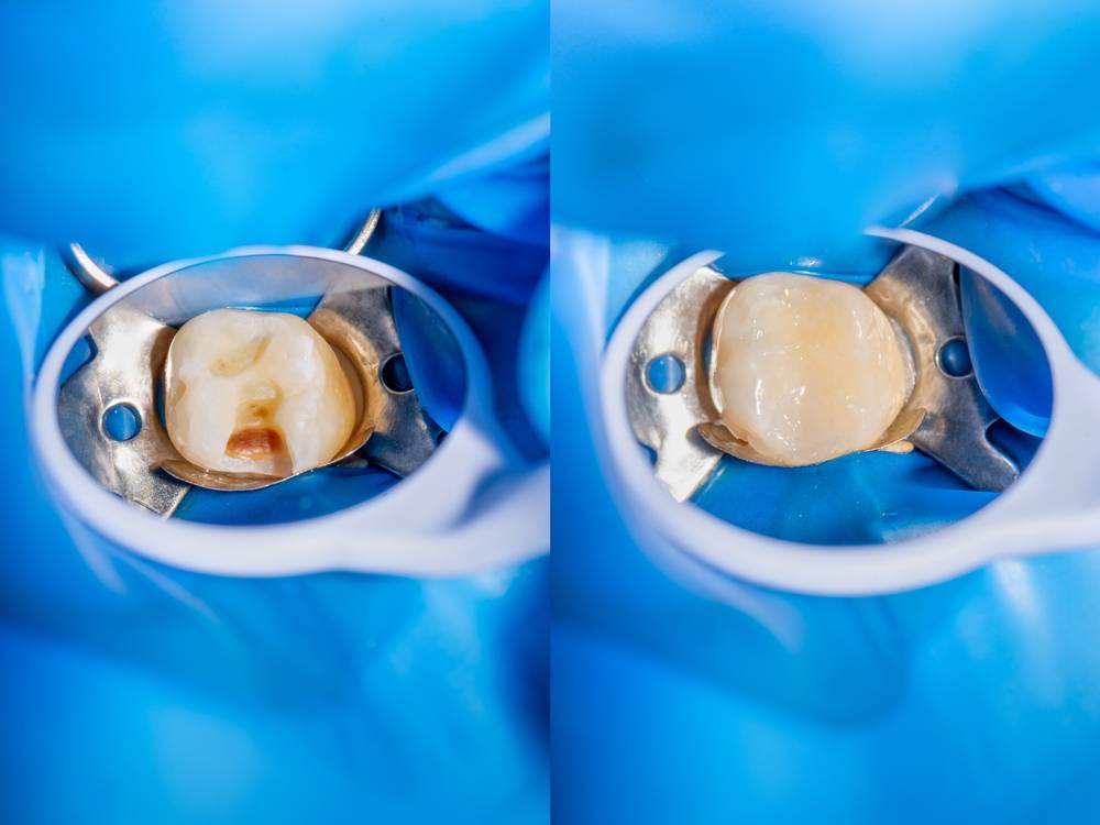 Composite filling Before and After