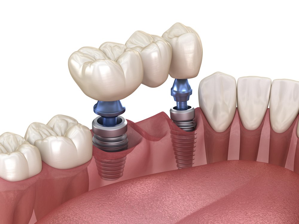 Caring for Your Dental Implants and Veneers