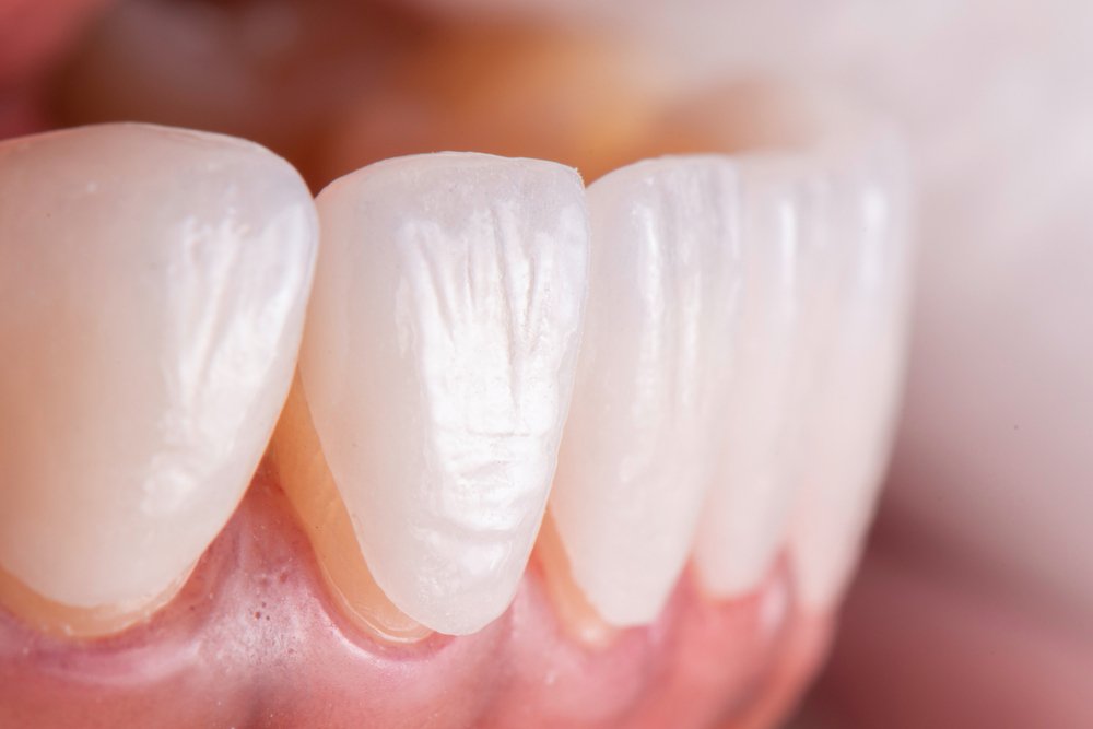 Caring for Your Porcelain Veneers and Maintaining Your Smile