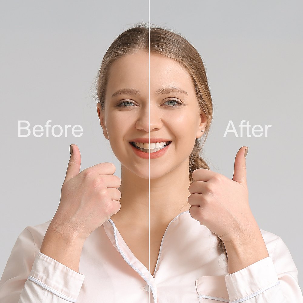 Caring for Your Veneers and Maintaining Your Smile