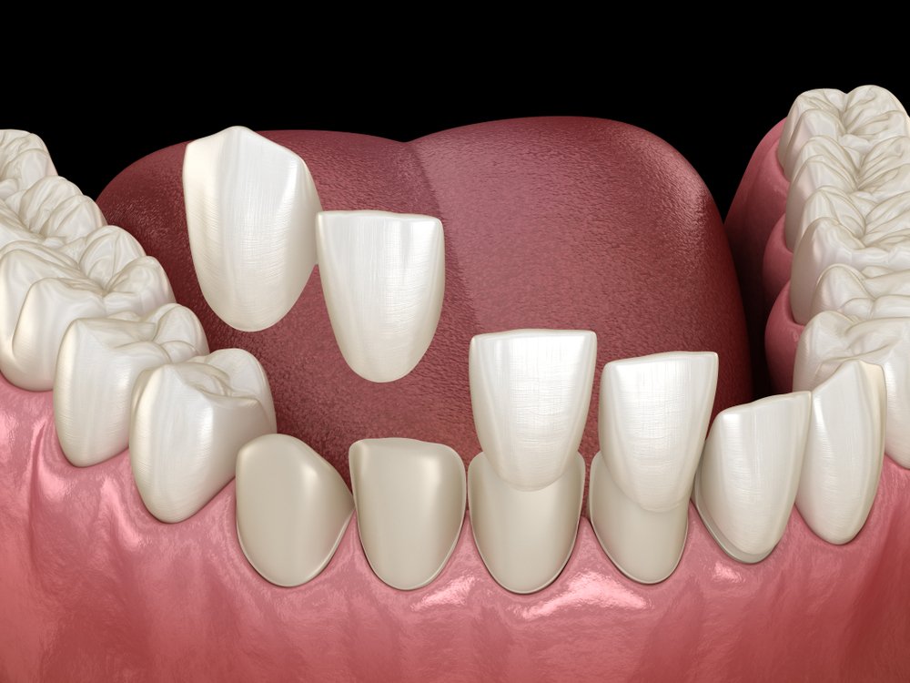 Comparing Dental Implants and Veneers