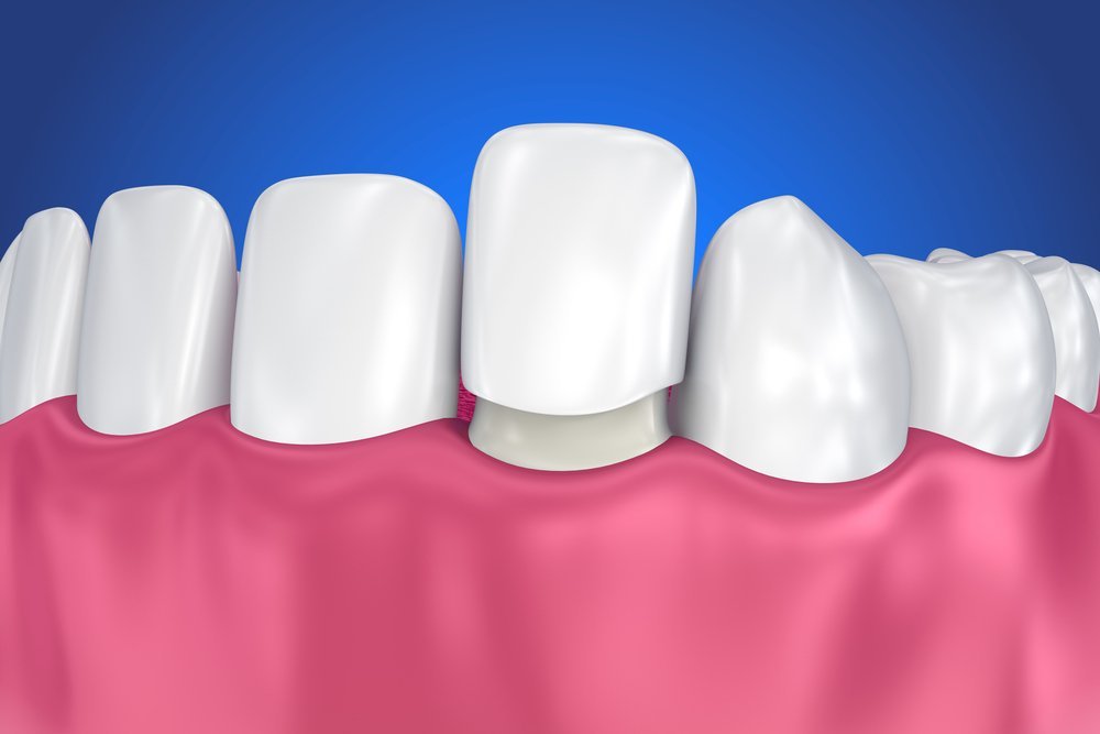 Financing and Payment Options for Veneers in Wisconsin