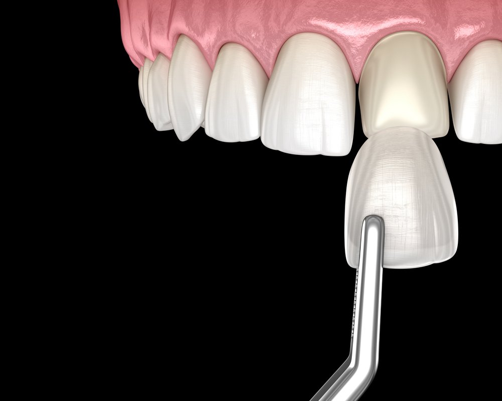 How much are veneers in ct (Connecticut)