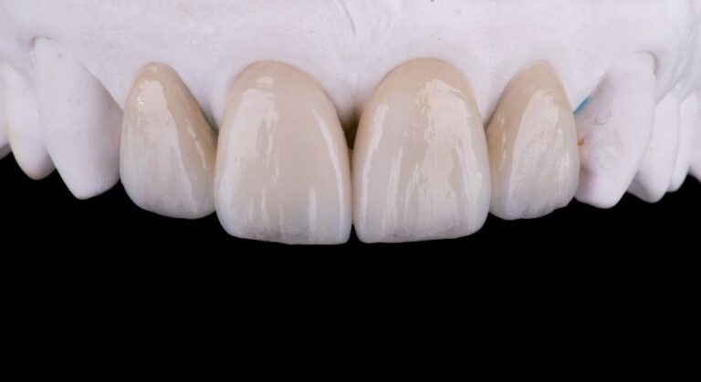 How much is a dental impland and veneers