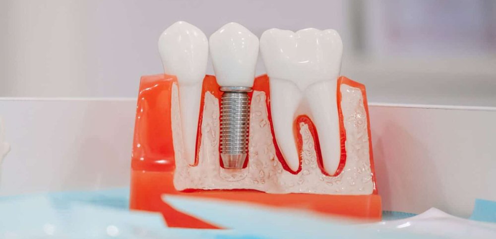 Tips for a Successful Recovery After Dental Implant Surgery
